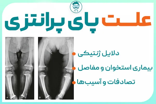 علت پای پرانتزی