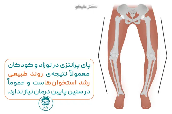 پاهای پرانتزی خفیف