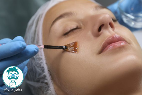 عکس اسیدتراپی پوست صورت