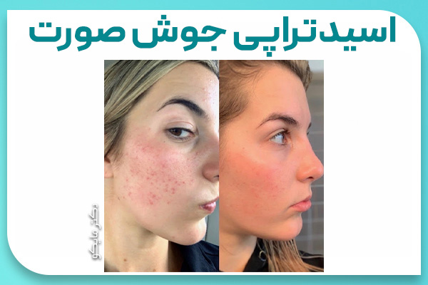 عکس قبل و بعد اسیدتراپی جوش صورت