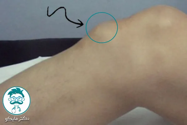 عوامل خطر بیماری ازگود اشلاتر