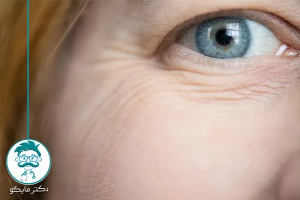 مشکل چین و چروک‌ دور چشم