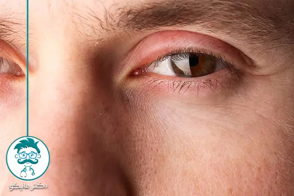 ورم و التهاب چشم