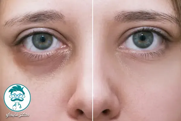 مشکل سیاهی دور چشم