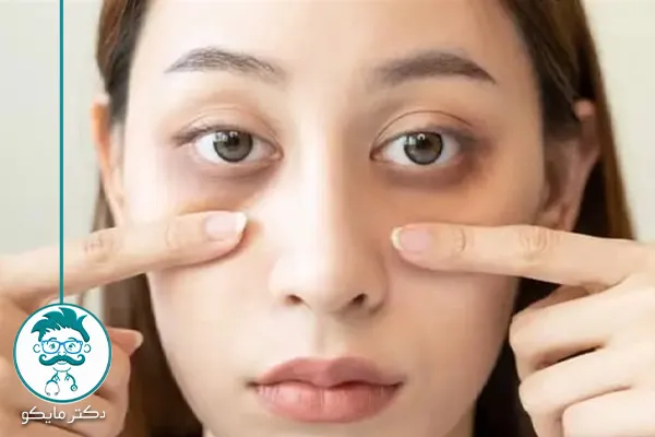 سیاهی زیر چشم 