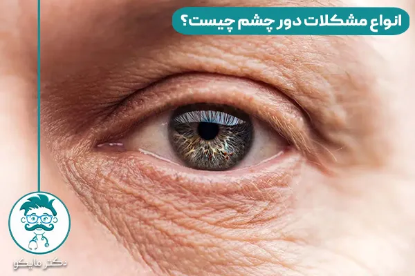 انواع مشکلات دور چشم چیست؟