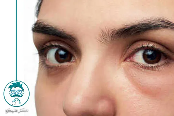 مشکل پف دور چشم