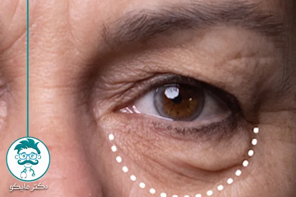 نازک شدن پوست زیر چشم