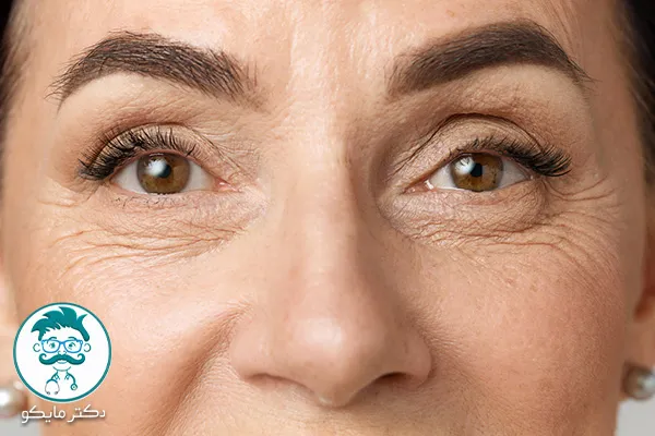 مشکلات پوست ژنتیکی دور چشم