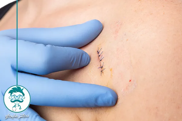 هزینه برداشتن خال