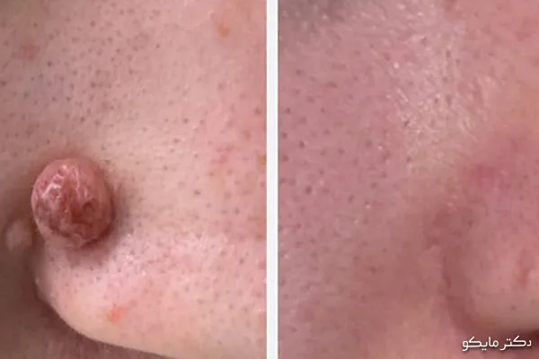 برداشتن خال صورت