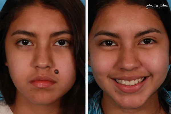 از بین بردن خال صورت در یک روز