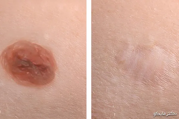 خال برداری با پلکسر