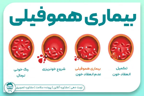 هموفیلی چیست؟