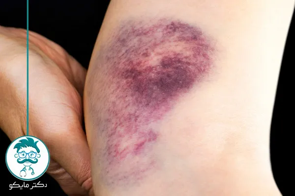 علائم خون مردگی زیر پوستی