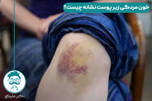 خون مردگی زیر پوست نشانه چیست؟