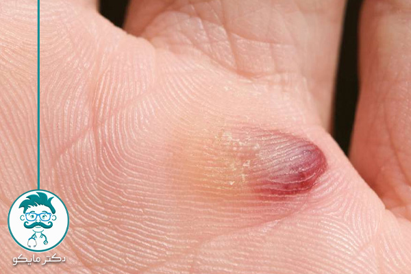 تشخیص خون مردگی زیر پوستی