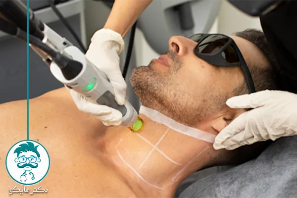 لیزر موهای زائد بدن