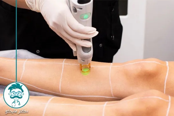 عوارض لیزر موهای زائد و سرطان