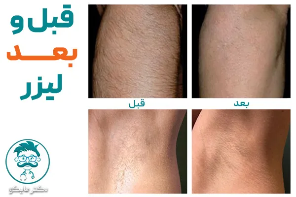 قبل و بعد لیزر موهای زائد خانگی