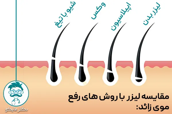 مقایسه لیزر موهای زائد بدن با سایر روش‌های حذف موهای زائد
