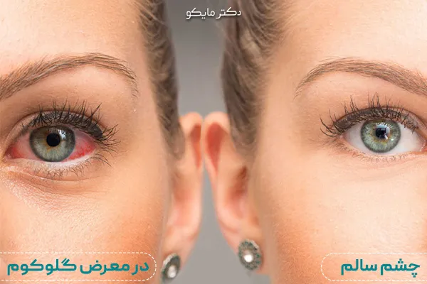 درمان‌ آب سیاه چشم