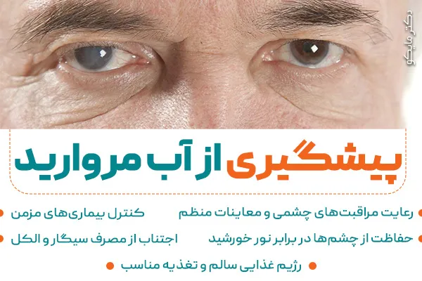 پیشگیری از آب مروارید چشم ها
