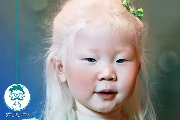 زندگی با آلبینیسم