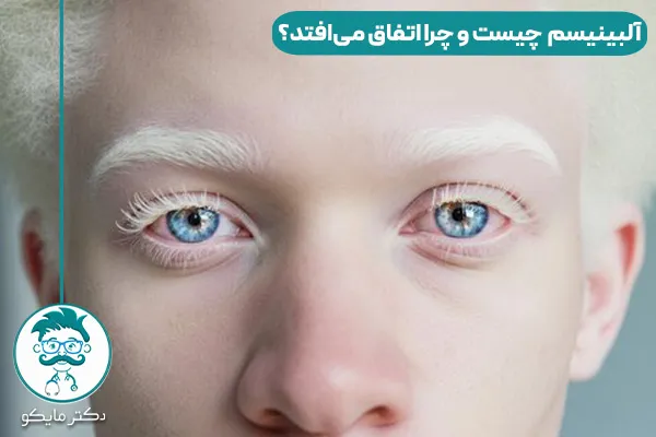 آلبینیسم چیست؟
