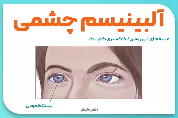 آلبینیسم چشم