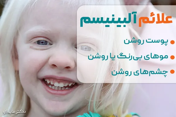 علائم آلبینیسم