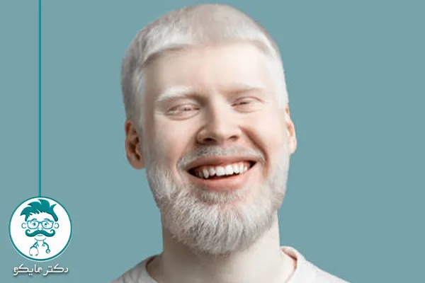 انواع آلبینیسم چیست؟