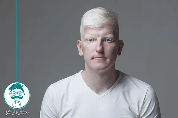 ازدواج آلبینیسم