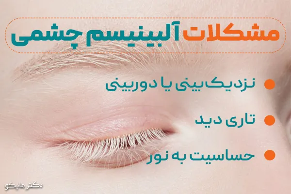 آلبینیسم چشمی