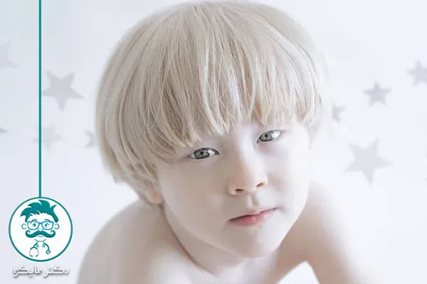 آلبینیسم خفیف