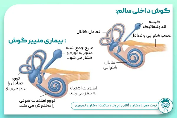 بیماری منییر گوش چیست؟
