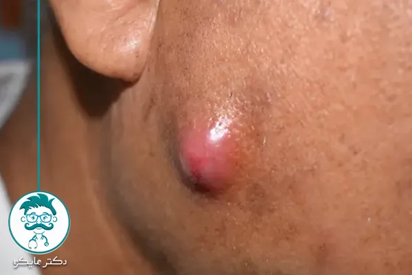 کورک صورت 