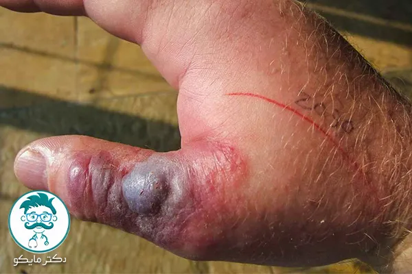 عکس مار گزیدگی