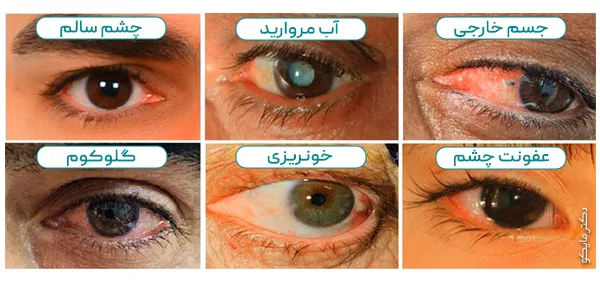 عکس بیماری های چشمی