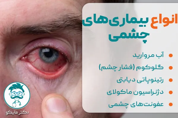 انواع بیماری های چشمی 