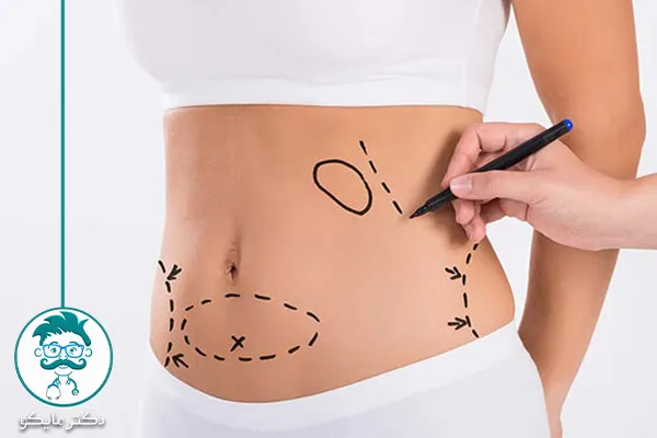 قبل و بعد ابدومینوپلاستی 