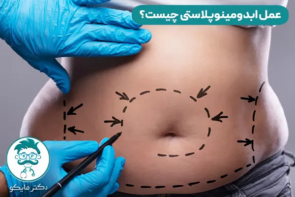 انواع ابدومینوپلاستی چیست؟ 