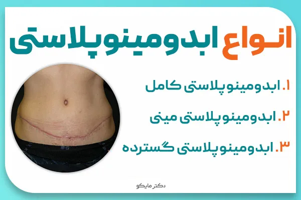 انواع ابدومینوپلاستی