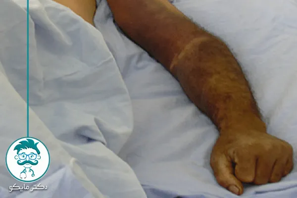 علائم تب کنگو بعد از چند روز مشخص میشود؟