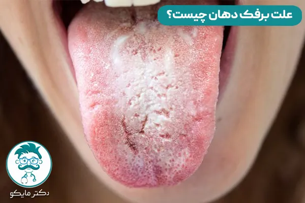 برفک دهان چیست؟