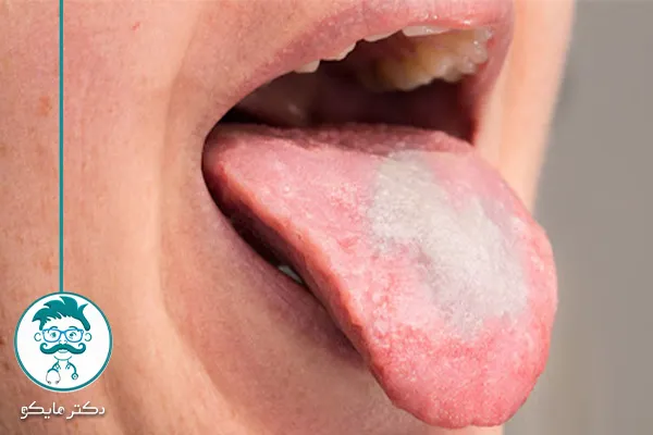 شکل ظاهری برفک دهان