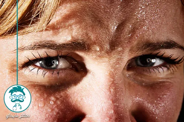 گلیکوپیرولات برای تعریق