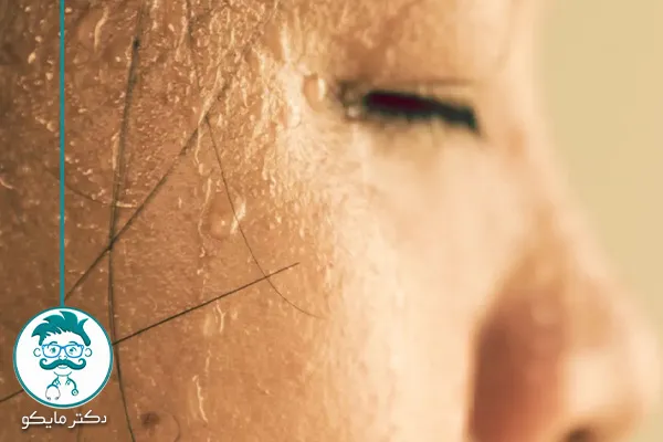 درمان عرق کردن و تعریق زیاد