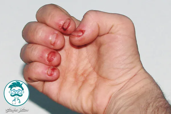 ناخن خوردن چه عوارضی دارد؟