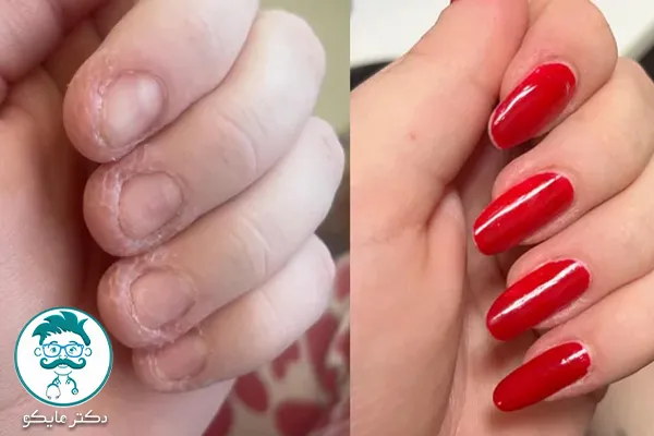 درمان جویدن ناخن